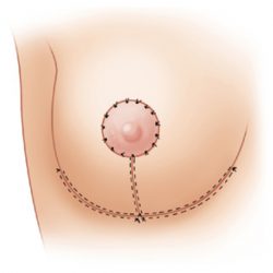 Tipos de cicatrices en reducción mamaria